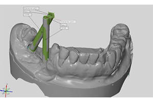 3D Scanner for medical reverse engineering